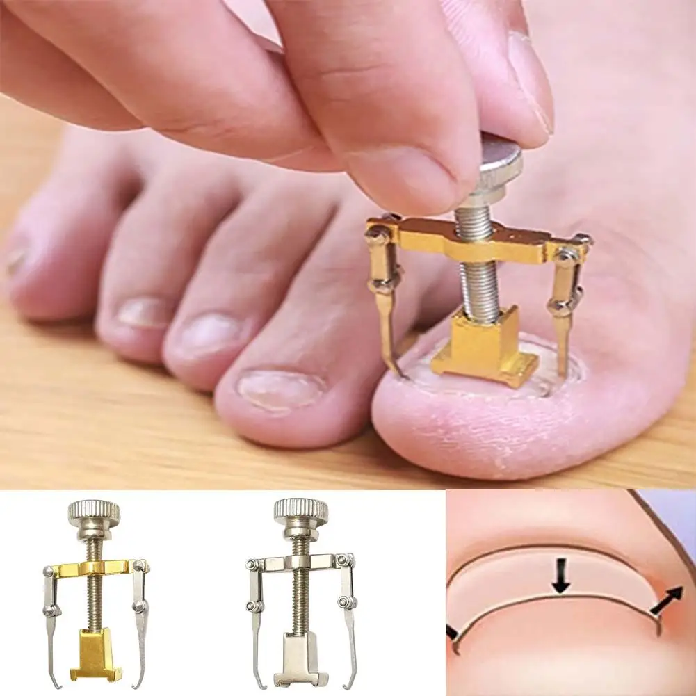 Ingrown Toenail Toe Fixer Recover Correction Device Pedicure Foot Nail Care Tool
Ingrown Toenail Toe Fixer Recover Correction Device Pedicure Foot Nail Care Tool