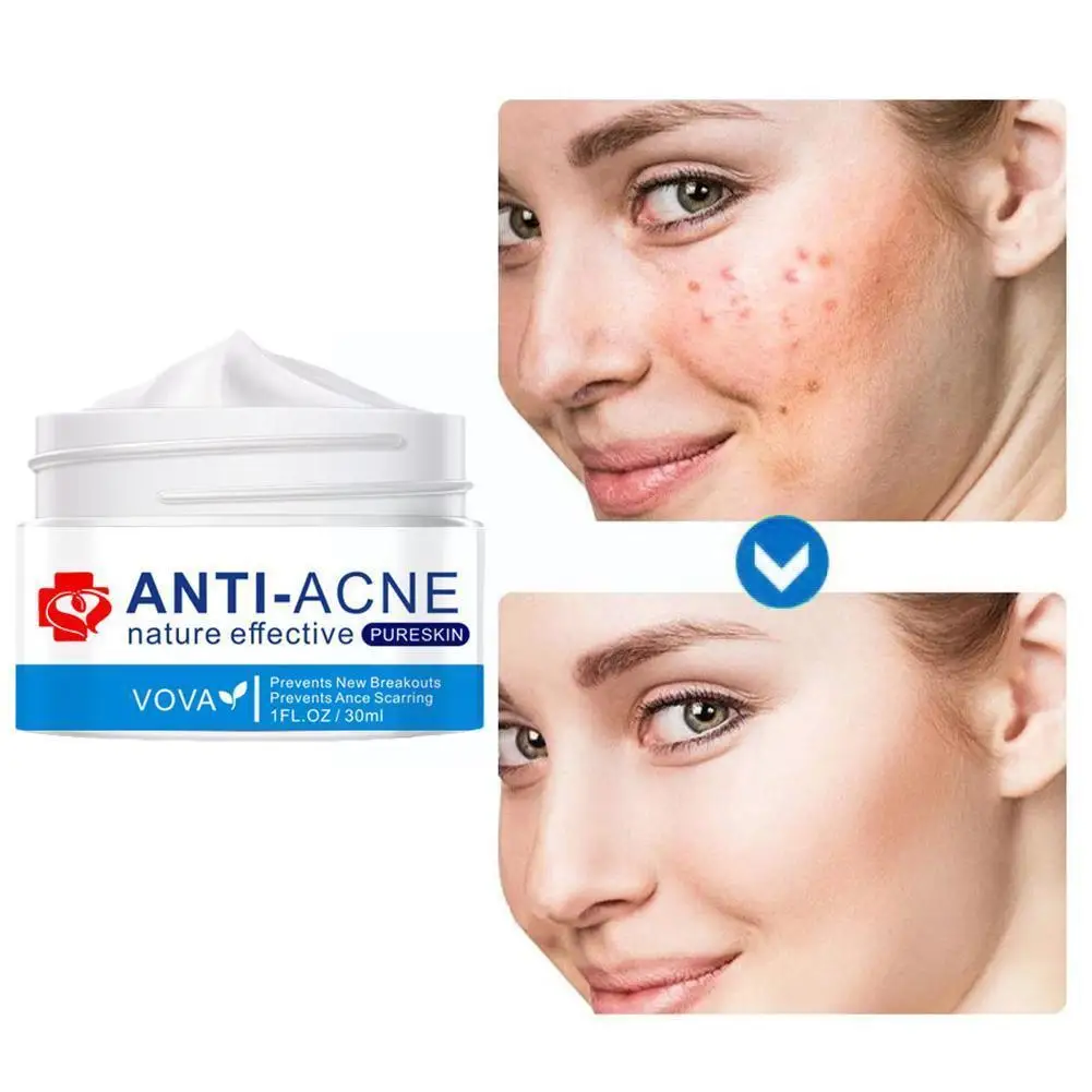 Effective Acne Removal Cream Acne Treatment Fade Acne Oil Shrink Care Acne Control Cream Skin Whitening Moisturizing Pores T2h4 
Effective Acne Removal Cream Acne Treatment Fade Acne Oil Shrink Care Acne Control Cream Skin Whitening Moisturizing Pores T2h4