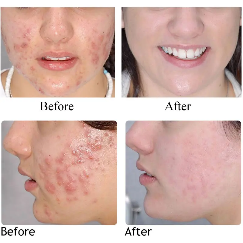 3PCS Red Acne Treatment Serum Oily Skin Pores Cleaning Antibacterial Pimple Removal Clear Acne Smoothing Serum Repair Skin Care
3PCS Red Acne Treatment Serum Oily Skin Pores Cleaning Antibacterial Pimple Removal Clear Acne Smoothing Serum Repair Skin Care