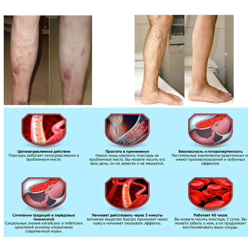 10pcs/lot Varicose vein treatment cream ointment vasculitis phlebitis spider vein pain varicose vasculitis removal herbal cream
10pcs/lot Varicose vein treatment cream ointment vasculitis phlebitis spider vein pain varicose vasculitis removal herbal cream