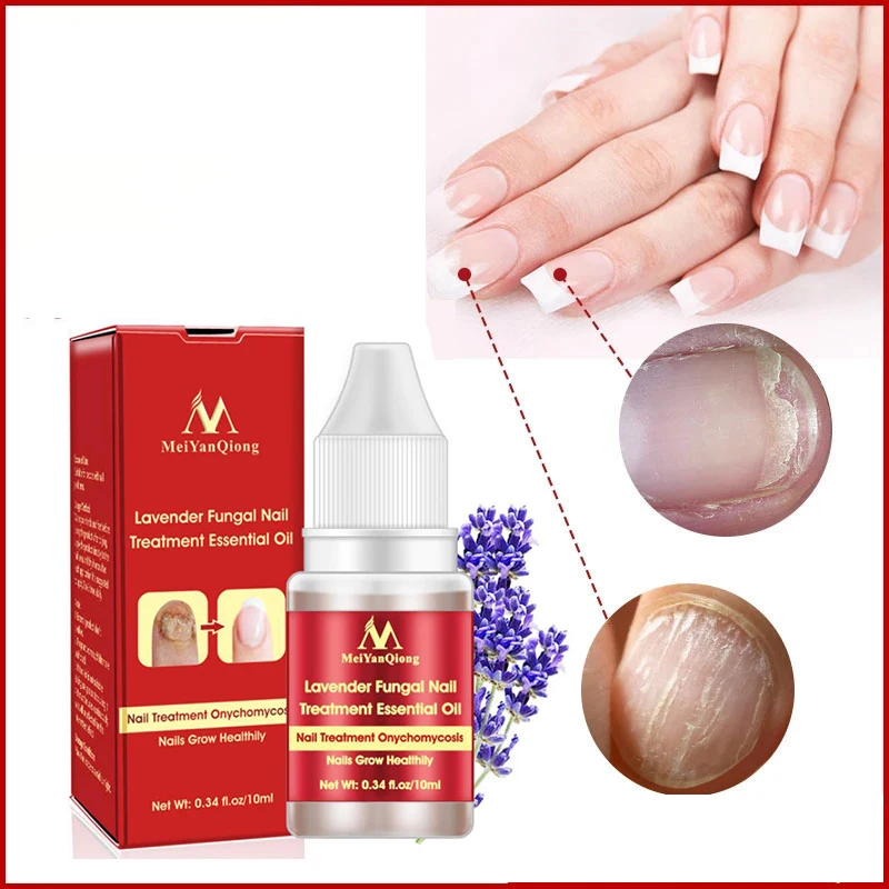 10ml Fungal Nail Treatment Serum Onychomycosis Paronychia Anti-Fungal Nail Infection Herbal Toe Fungus Foot Repair Essence Care
10ml Fungal Nail Treatment Serum Onychomycosis Paronychia Anti-Fungal Nail Infection Herbal Toe Fungus Foot Repair Essence Care