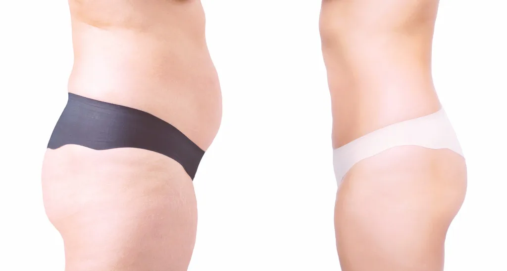 Lipolytic Solution Fat Burning Site slimming Body slim and thin and beautiful