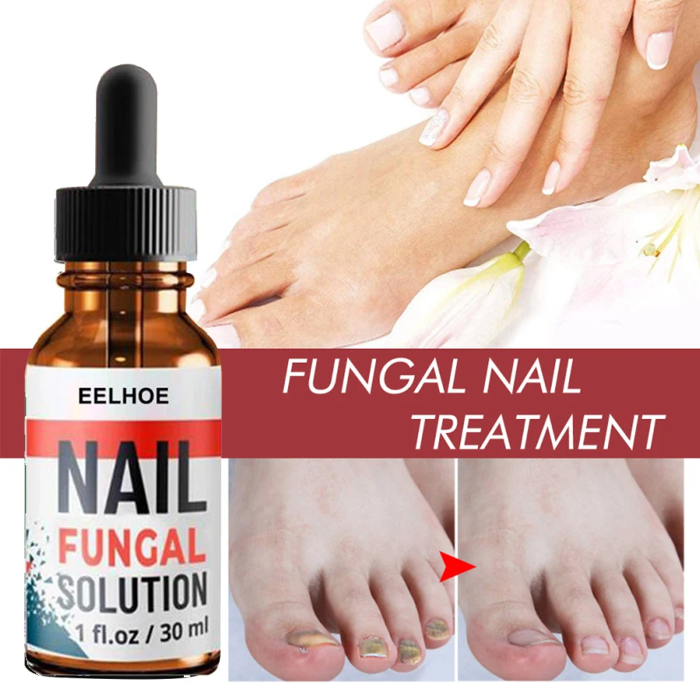 Fungal Nail Repair Essence Serum Care Treatment Foot Nail Fungus Removal Gel Anti Infection Paronychia Onychomycosis Care
Fungal Nail Repair Essence Serum Care Treatment Foot Nail Fungus Removal Gel Anti Infection Paronychia Onychomycosis Care