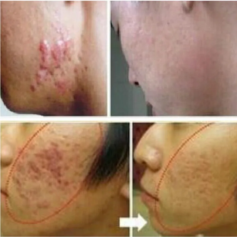 Acne Scar Removal Cream Skin Repair Face Cream Acne Treatment Blackhead Acne Spots Whitening Cream Stretch Marks 30ml
Acne Scar Removal Cream Skin Repair Face Cream Acne Treatment Blackhead Acne Spots Whitening Cream Stretch Marks 30ml