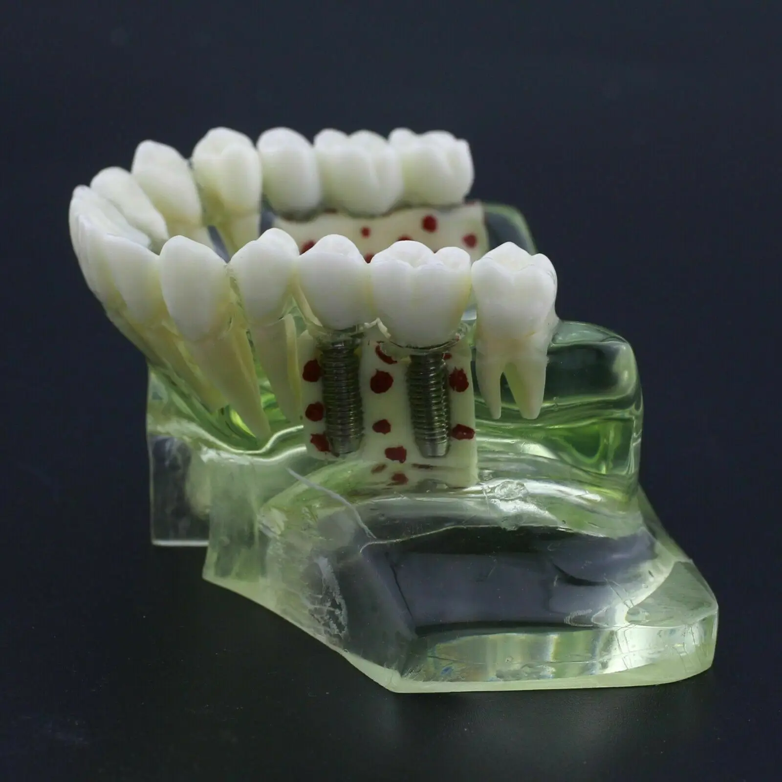 Dental Teaching Model NISSIN Kilgore Implant Upper Jaw Sinus Crown Bridge Education For Student Practice
Dental Teaching Model NISSIN Kilgore Implant Upper Jaw Sinus Crown Bridge Education For Student Practice