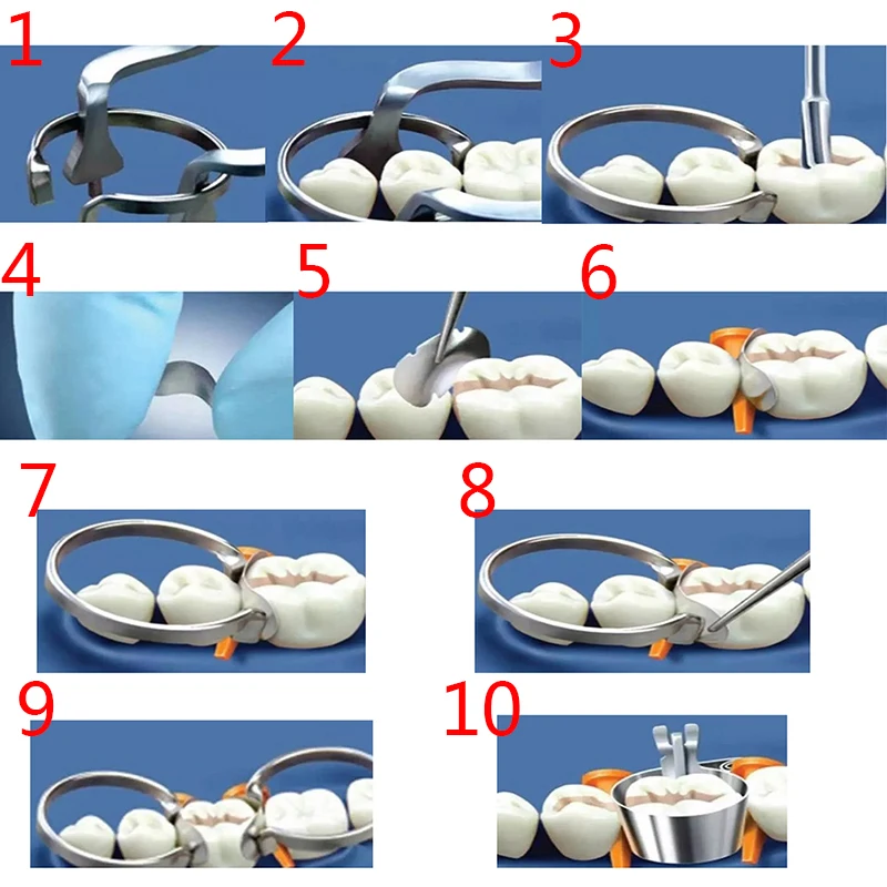 100 Pcs/Set Dental Sectional Contoured Matrices Matrix Ring Delta Wedges Filling Wholesale
100 Pcs/Set Dental Sectional Contoured Matrices Matrix Ring Delta Wedges Filling Wholesale