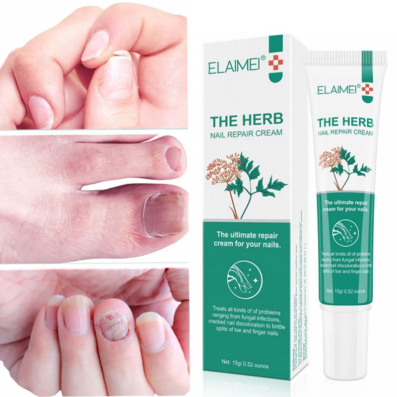 Herbal Fungal Nail Repair Cream Soften Nail Anti Fungus Nails Treatment Gel Remove Onychomycosis Paronychia Toenail Care 15g
Herbal Fungal Nail Repair Cream Soften Nail Anti Fungus Nails Treatment Gel Remove Onychomycosis Paronychia Toenail Care 15g