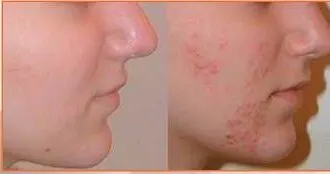 Fucidin Cream 20g (3pcs) Pimples,Acne scars, Wrinkles and Psoriasis, Long Expiry, free Shipping - 3 PACK
Fucidin Cream 20g (3pcs) Pimples,Acne scars, Wrinkles and Psoriasis, Long Expiry, free Shipping - 3 PACK