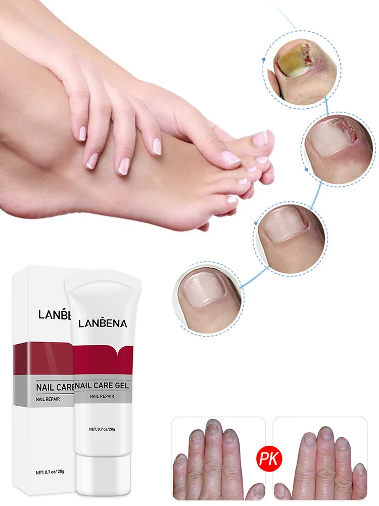 LANBENA Nail Care Gel Fungal Nail Treatment Remove Onychomycosis Nail Care Nourishing Effective against nail Hand And Foot Care
LANBENA Nail Care Gel Fungal Nail Treatment Remove Onychomycosis Nail Care Nourishing Effective against nail Hand And Foot Care