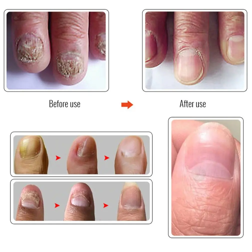 Lavender Nail Essential Oil Rich In Natural Health Ingredients Essential Oil Remove Onychomycosis Essential Oil
Lavender Nail Essential Oil Rich In Natural Health Ingredients Essential Oil Remove Onychomycosis Essential Oil