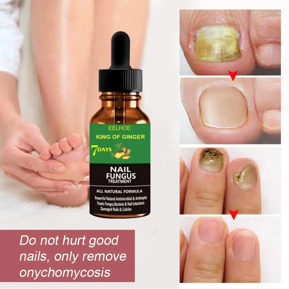 50ml Ginger Foot Antifungal Nail Essence Nails Care Repair Nail Fungal Treatment Anti-Fungus Onychomycosis Removal Liquid
50ml Ginger Foot Antifungal Nail Essence Nails Care Repair Nail Fungal Treatment Anti-Fungus Onychomycosis Removal Liquid