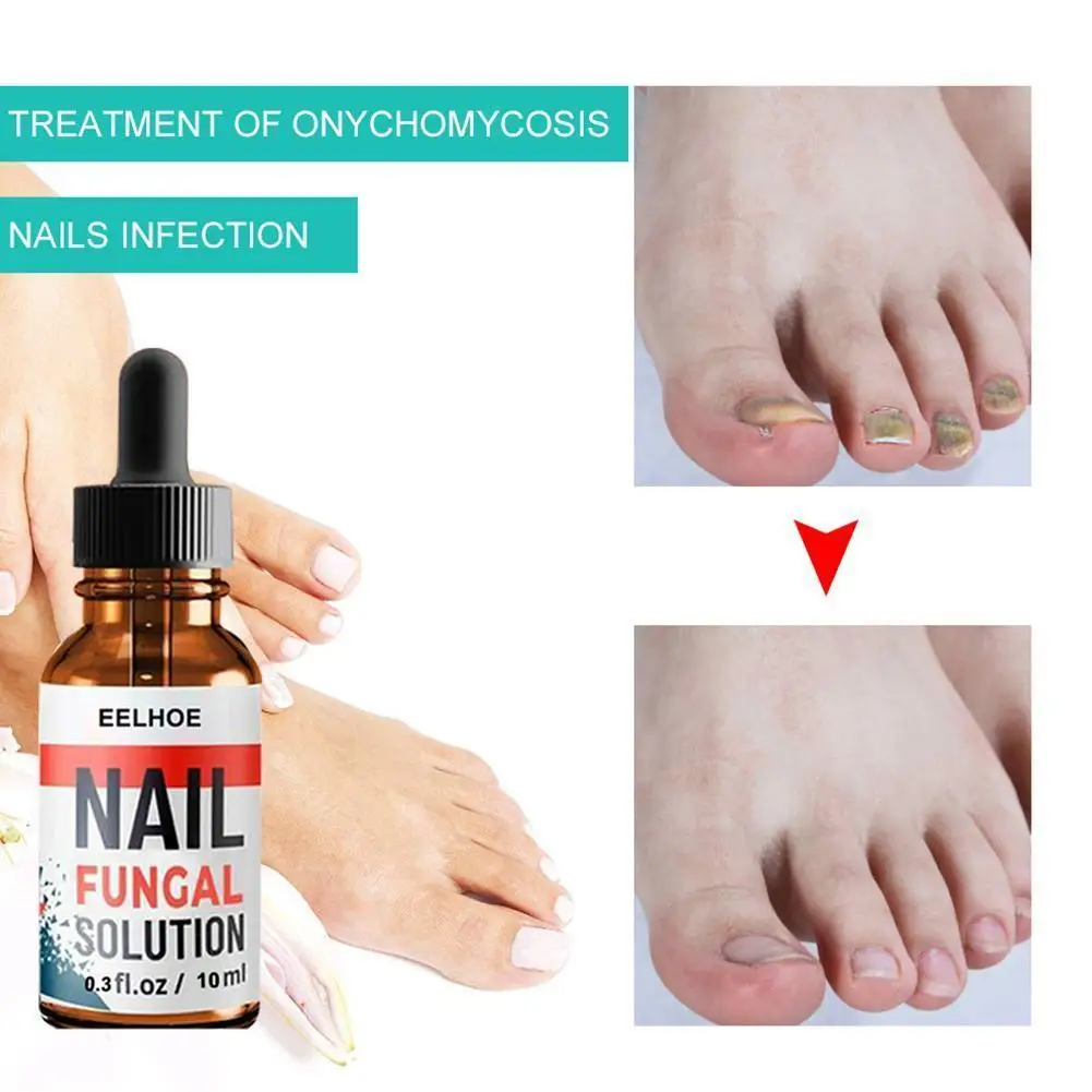 30ml Nail Repair Essence Onychomycosis Care Treatment Repair Damaged Nail Bed Removal Gel Paronychia Onychomycosis Infected Toen
30ml Nail Repair Essence Onychomycosis Care Treatment Repair Damaged Nail Bed Removal Gel Paronychia Onychomycosis Infected Toen