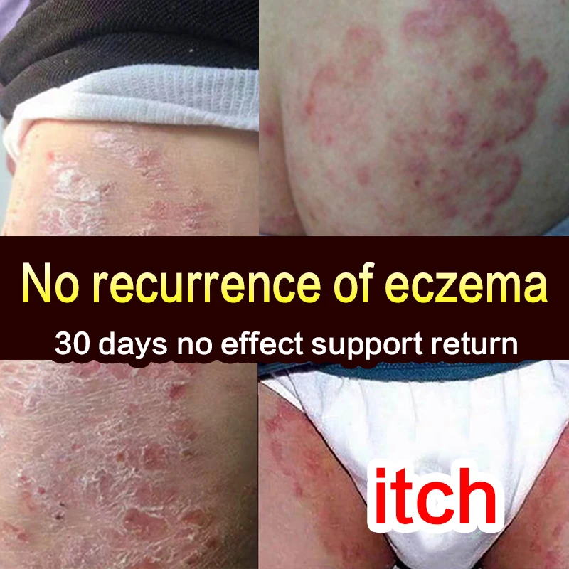 Natural Herbal Body Psoriasis Cream Medicine Relieve Anti-Itch Ointment Nursing Effective Anti Fungus Itching Cream Skin Care
Natural Herbal Body Psoriasis Cream Medicine Relieve Anti-Itch Ointment Nursing Effective Anti Fungus Itching Cream Skin Care