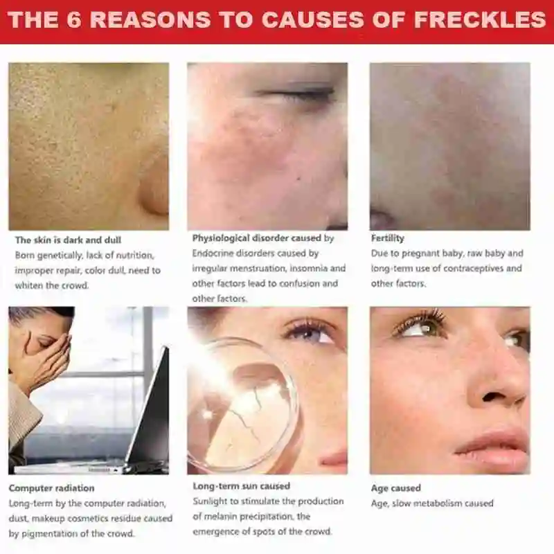 Facial spot removal cream Effective Whitening Remove Melasma Melanin Dark Spots Repair Fade Freckls face cream
Facial spot removal cream Effective Whitening Remove Melasma Melanin Dark Spots Repair Fade Freckls face cream