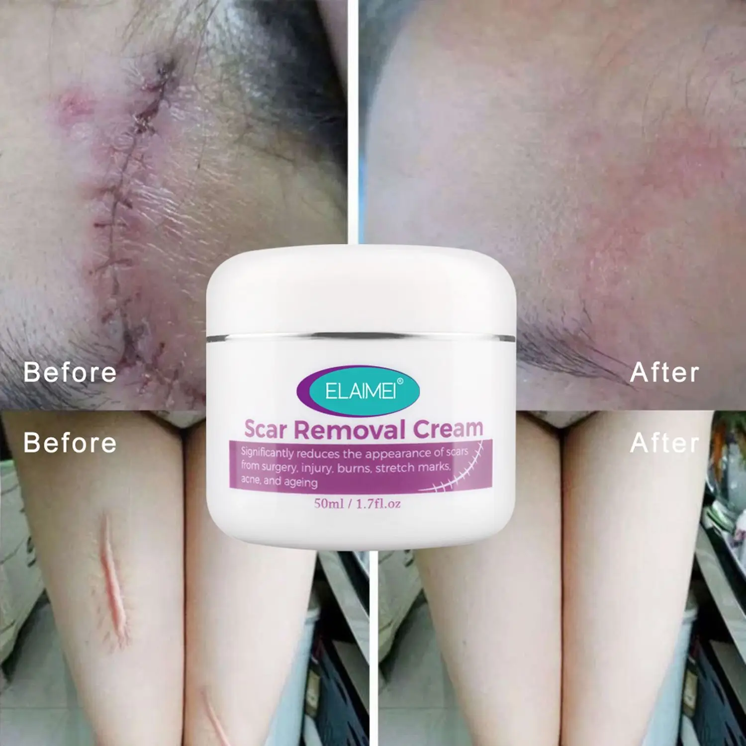 Hot Sale Treatment ELAIMEI Skin Repair Skin Rebound Scarless Cream Wounds Scar Removal Stretch Marks
Hot Sale Treatment ELAIMEI Skin Repair Skin Rebound Scarless Cream Wounds Scar Removal Stretch Marks