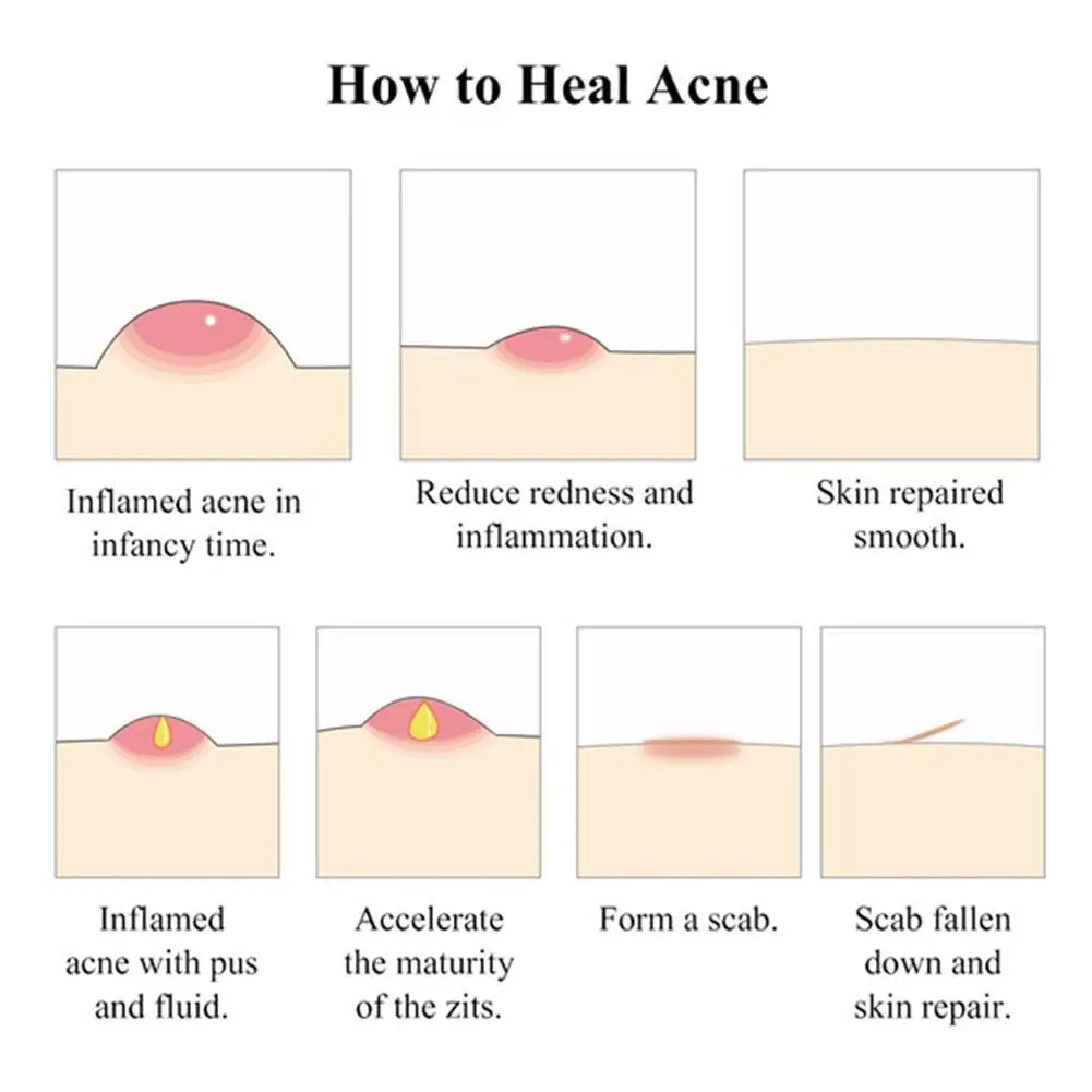 Effective Acne Removal Cream Acne Treatment Fade Acne Spots Oil Control Shrink Pores Whitening Moisturizing Acne Cream Skin Care
Effective Acne Removal Cream Acne Treatment Fade Acne Spots Oil Control Shrink Pores Whitening Moisturizing Acne Cream Skin Care