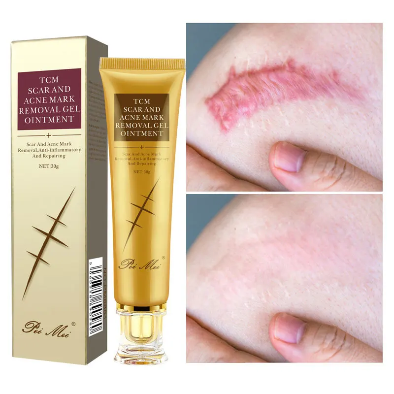 30g Acne Scar Removal Cream Pimples Stretch Marks Face Gel Remove Acne Smoothing Whitening Moisturizing Body Skin Care Aichun
30g Acne Scar Removal Cream Pimples Stretch Marks Face Gel Remove Acne Smoothing Whitening Moisturizing Body Skin Care Aichun