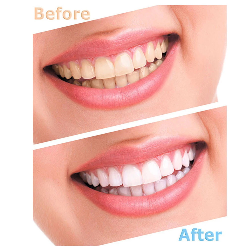Top Quality Tooth Whitener New Dental Equipment Bright White Smile Teeth Whitening Peroxide Dental Bleaching System Oral Gel Kit
Top Quality Tooth Whitener New Dental Equipment Bright White Smile Teeth Whitening Peroxide Dental Bleaching System Oral Gel Kit