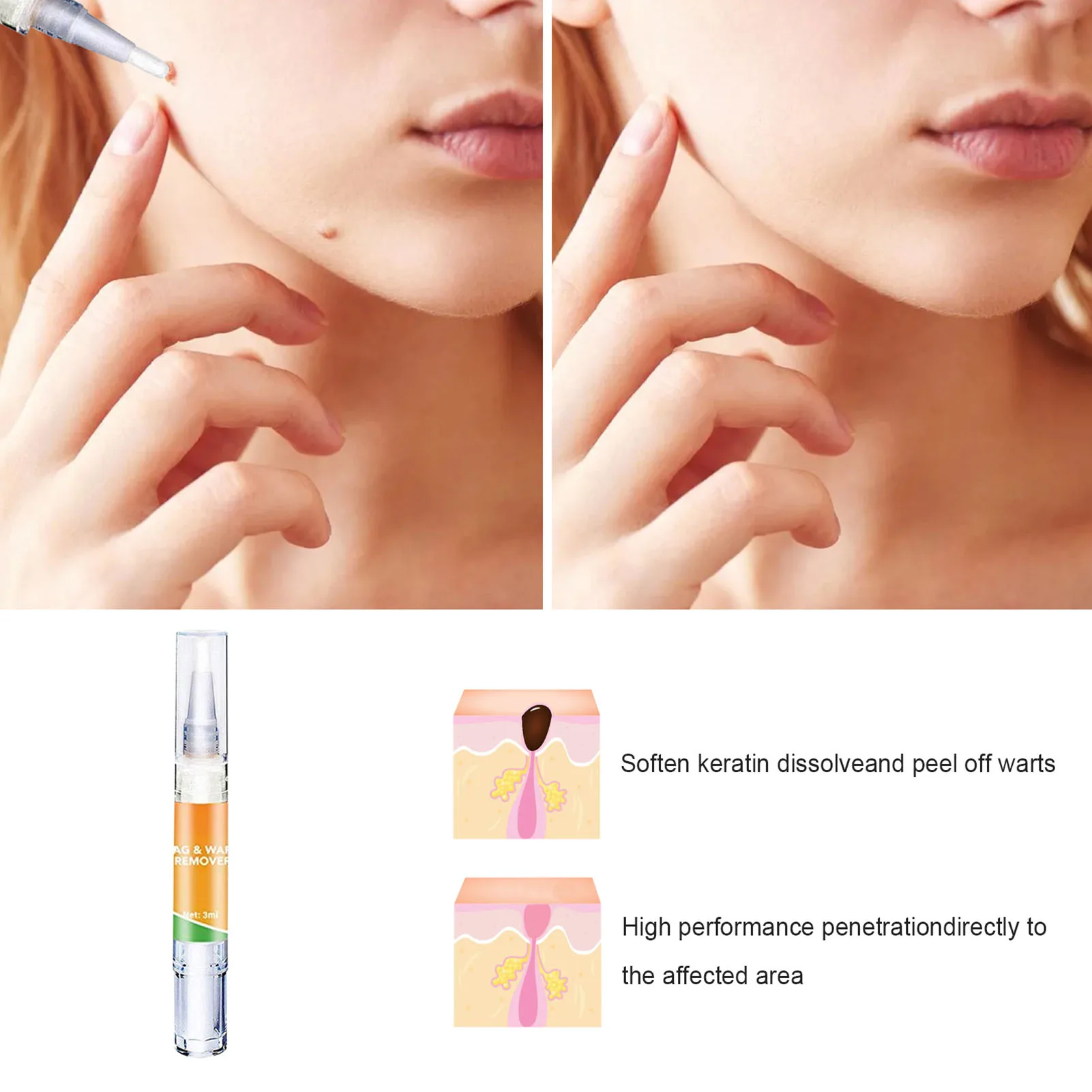 2pcs 3ml Tags & Moles Remover Liquid Wart Removal Pen Genital Wart Treatment From Skin Tags Removing Against Moles Remover
2pcs 3ml Tags & Moles Remover Liquid Wart Removal Pen Genital Wart Treatment From Skin Tags Removing Against Moles Remover