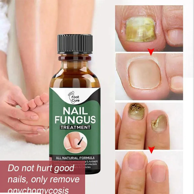 Fungal Nail Repair Essence Serum Care Treatment Toenail Fungus Removal Gel Repair Onychomycosis Fluid To Thicken Soft Nails
Fungal Nail Repair Essence Serum Care Treatment Toenail Fungus Removal Gel Repair Onychomycosis Fluid To Thicken Soft Nails
