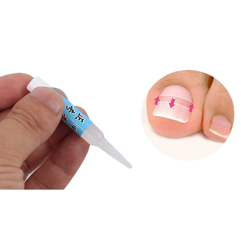 NEW-Nail Glue Ingrown Toenail Correction Pedicure Toe Patch Adhesive Foot Care Tool #8
NEW-Nail Glue Ingrown Toenail Correction Pedicure Toe Patch Adhesive Foot Care Tool #8
