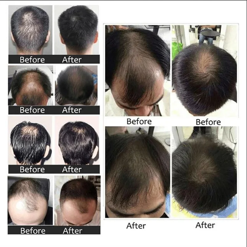 Oriental Oils Hair Nutrition Hair Loss Treatment Solutions Product Fast Hair Growth Remedy Essence Oil Hair Regrowth Products
Oriental Oils Hair Nutrition Hair Loss Treatment Solutions Product Fast Hair Growth Remedy Essence Oil Hair Regrowth Products