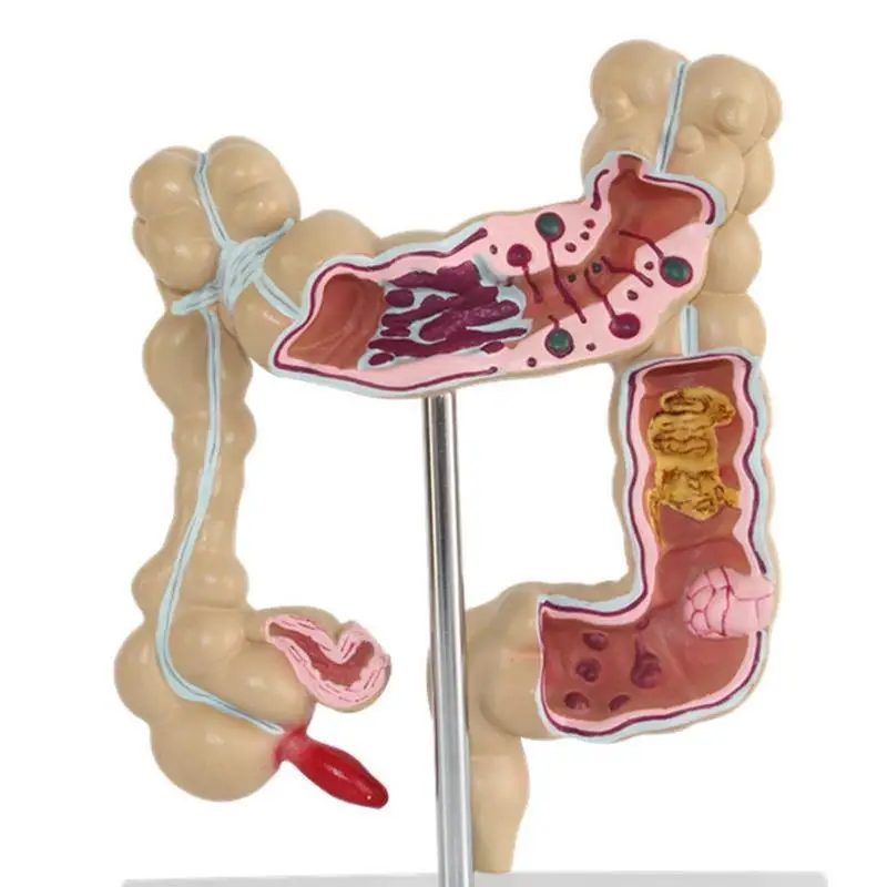 Colorectal lesion model human colon snake large intestine pathological diseases model medical organizer anatomy
Colorectal lesion model human colon snake large intestine pathological diseases model medical organizer anatomy