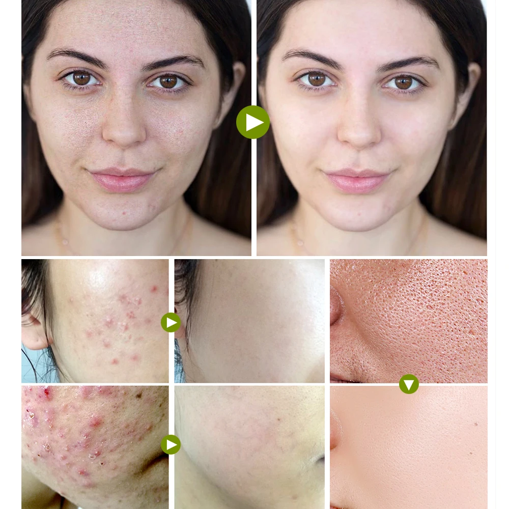 Tea Tree acne Repair face serum face cream set Remove Scar Treatment serum Acne print essence cream skin care VIBRANT GLAMOUR
Tea Tree acne Repair face serum face cream set Remove Scar Treatment serum Acne print essence cream skin care VIBRANT GLAMOUR
