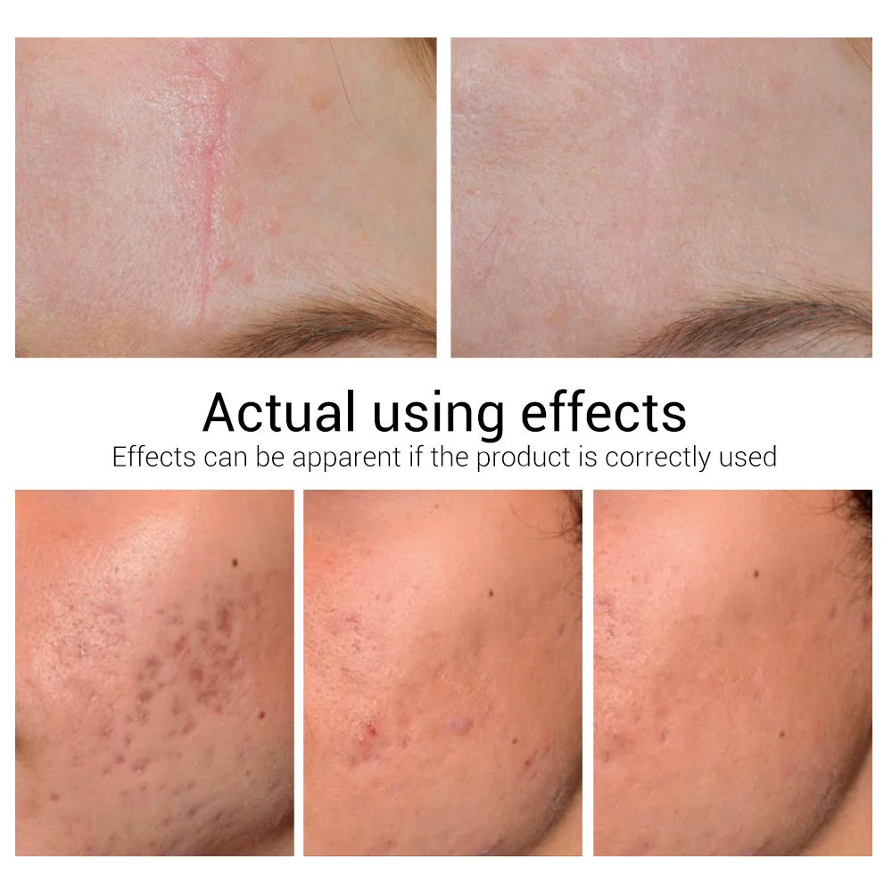 LANBENA Acne Scar Remove Serum Acne Treatment Remover Stretch Marks Anti Acne Shrink Pores Blackhead Whitening Cream Skin Care
LANBENA Acne Scar Remove Serum Acne Treatment Remover Stretch Marks Anti Acne Shrink Pores Blackhead Whitening Cream Skin Care