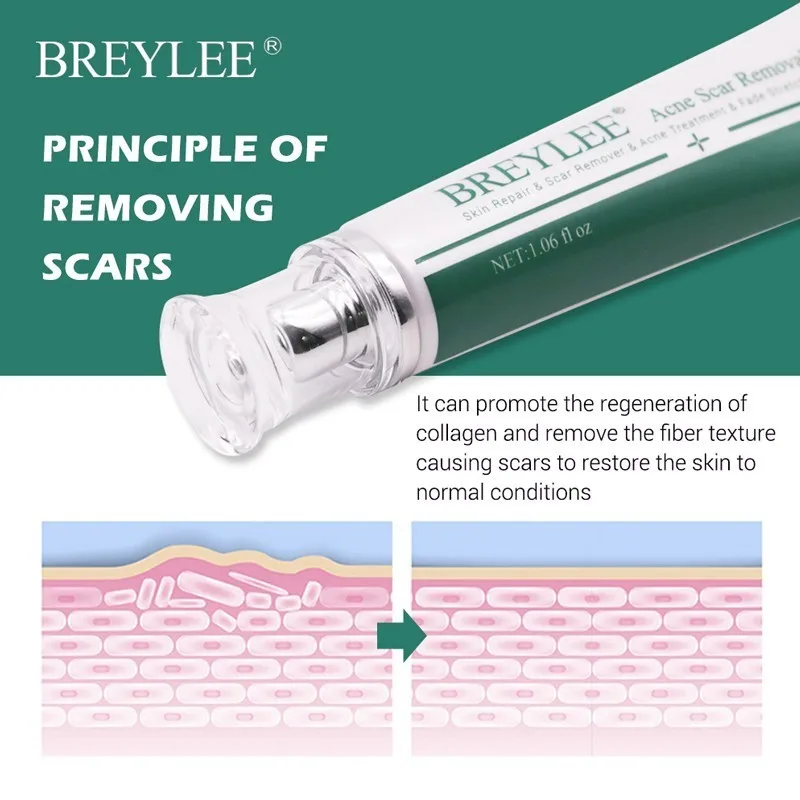 BREYLEE Scar Acne Treatment Anti-aging Moisturizing Face Cream Remove Whitening Repair Stretch Marks Acne Spots 30g Skin Care
BREYLEE Scar Acne Treatment Anti-aging Moisturizing Face Cream Remove Whitening Repair Stretch Marks Acne Spots 30g Skin Care