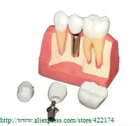 Free Shipping Implant analysis model dental tooth teeth dentist anatomical anatomy model odontologia
Free Shipping Implant analysis model dental tooth teeth dentist anatomical anatomy model odontologia