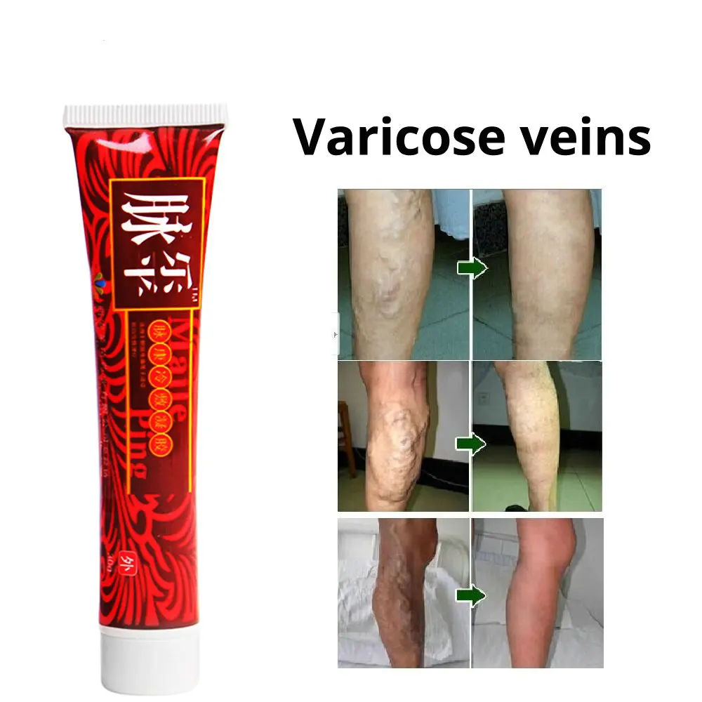 Varicose Veins Treatment Cream Effective cure Vasculitis Phlebitis Spider Veins Pain Varicosity Angiitis ointment No box 30g
Varicose Veins Treatment Cream Effective cure Vasculitis Phlebitis Spider Veins Pain Varicosity Angiitis ointment No box 30g