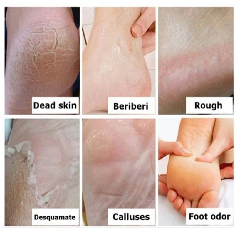ZhanTing 3 Pcs / Oil Feet Cream Beriberi Cream for Athlete's Foot Feet Itch Blisters Anti-chapping Peeling for Foot Care Cream
ZhanTing 3 Pcs / Oil Feet Cream Beriberi Cream for Athlete's Foot Feet Itch Blisters Anti-chapping Peeling for Foot Care Cream