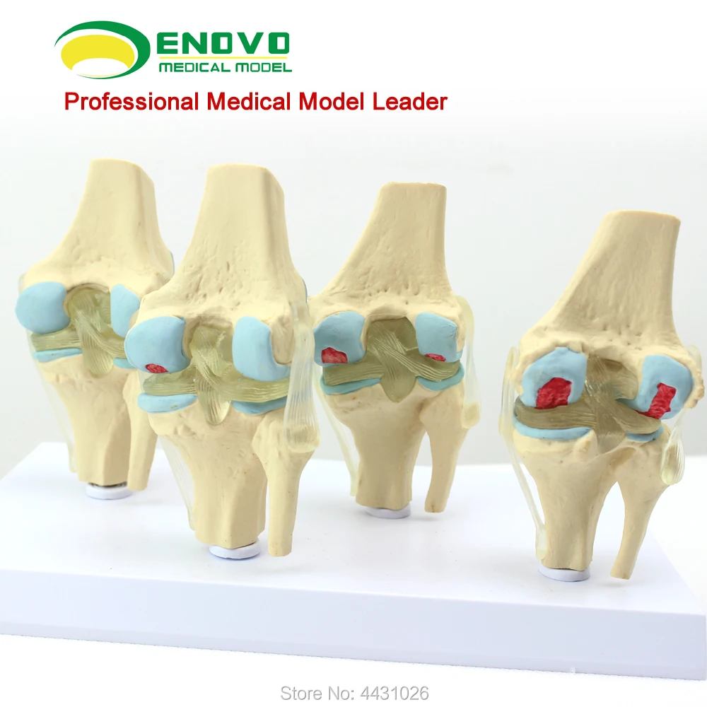 ENOVO Human pathological knee model degenerative hemophilia orthopedic pain tube bone model
ENOVO Human pathological knee model degenerative hemophilia orthopedic pain tube bone model