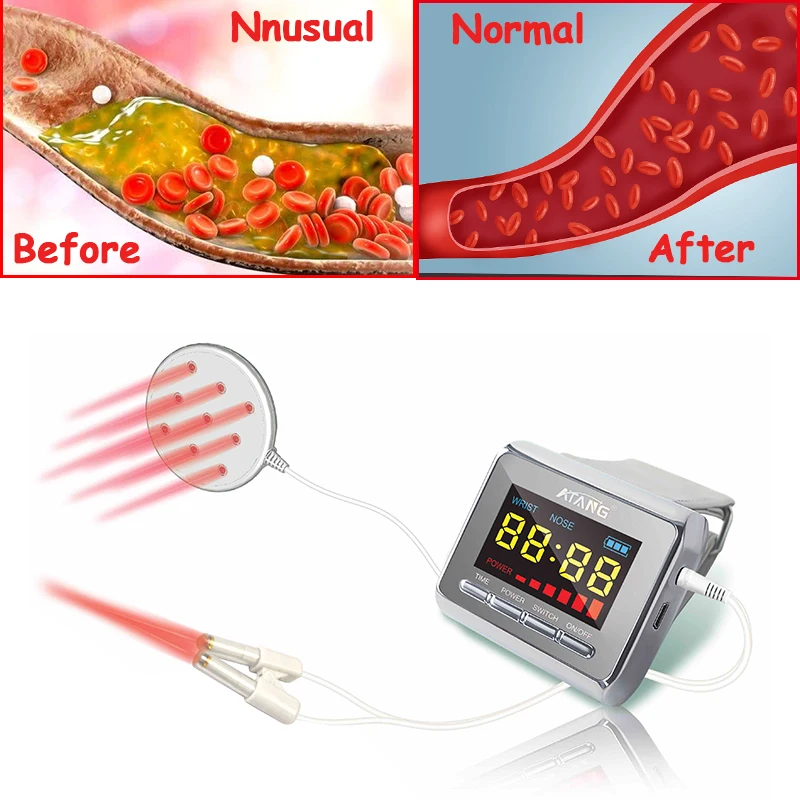 Lower blood Pressure Reduce Blood lipids Hypertension medical laser therap[y device Treatment of Nose Clip
Lower blood Pressure Reduce Blood lipids Hypertension medical laser therap[y device Treatment of Nose Clip