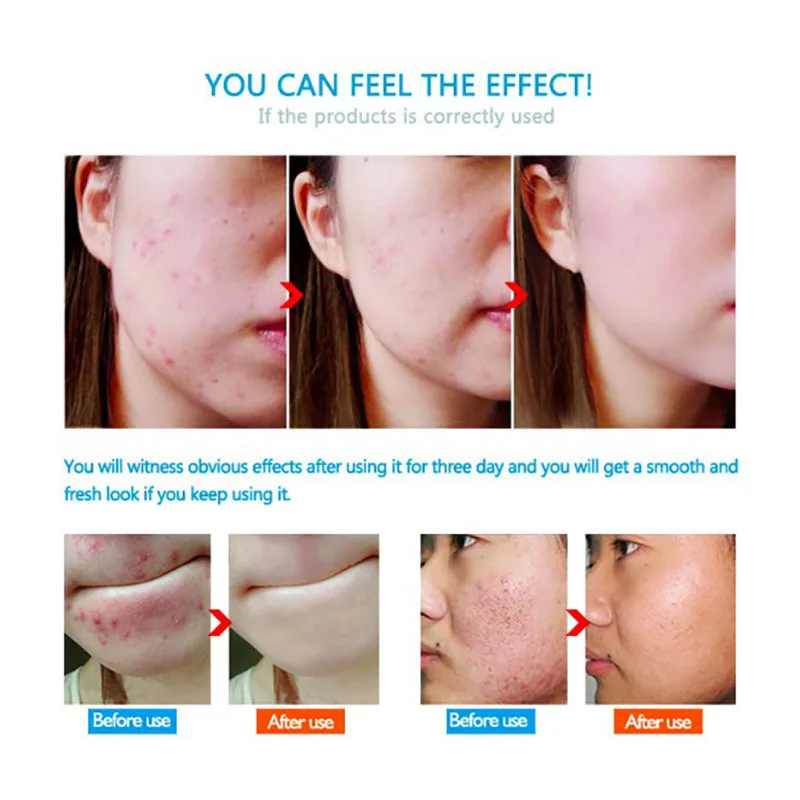 Face Cream Whitening Skin Care Anti Acne Treatment Oil Control Moisturizing Scar Remover Pores Clareador De Pele Anti Aging
Face Cream Whitening Skin Care Anti Acne Treatment Oil Control Moisturizing Scar Remover Pores Clareador De Pele Anti Aging
