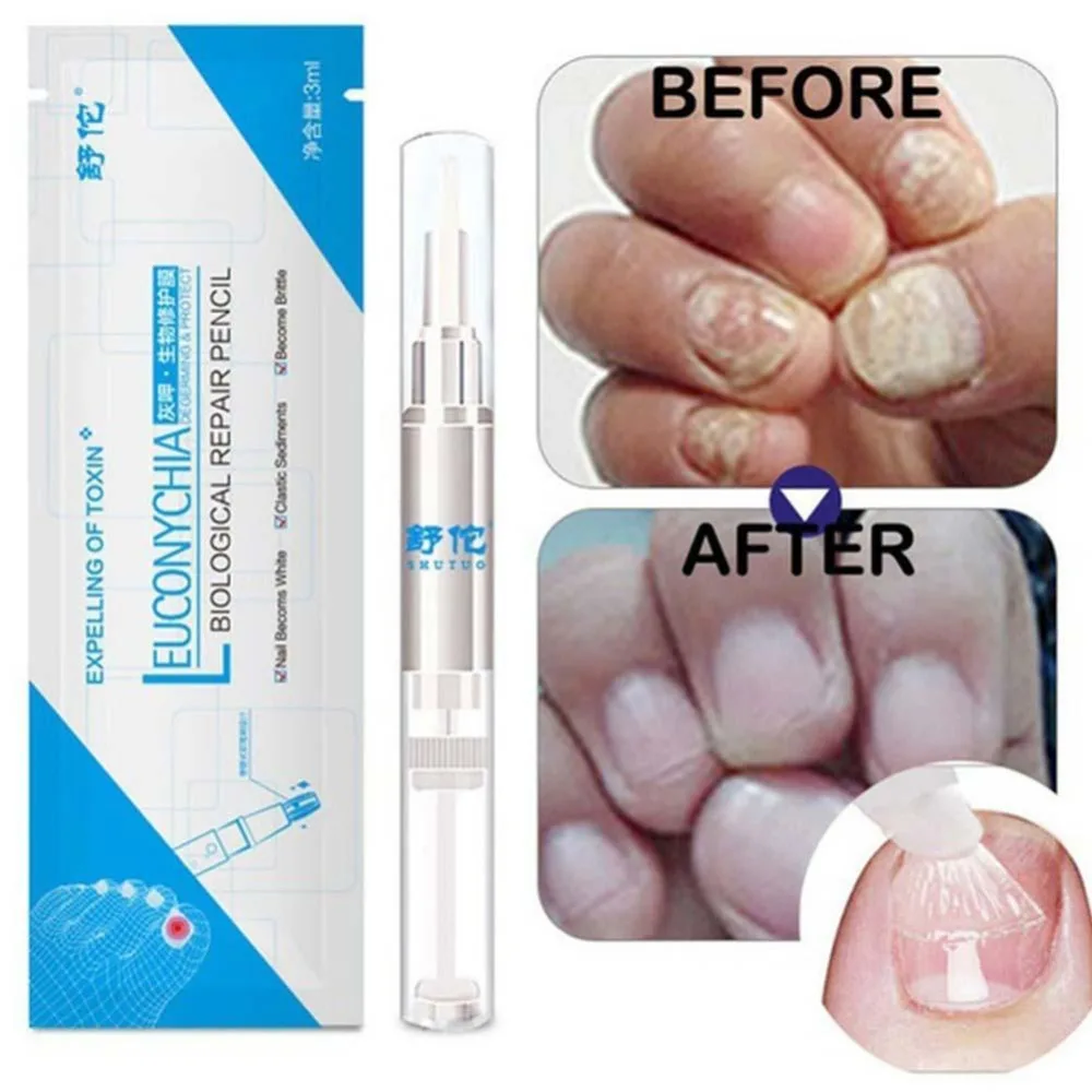 3ml Nail Fungal Treatment Pen Anti Fungus Infection Biological Repair Solution Nutritious Oil Fingernails Toenails Care | Красота и