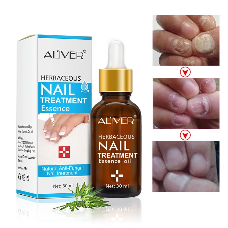 Aliver Nail Treatment Feet Care Essence Nail Foot Whitening Toe Nail Fungus Removal Gel Anti Infection Paronychia Onychomycosis
Aliver Nail Treatment Feet Care Essence Nail Foot Whitening Toe Nail Fungus Removal Gel Anti Infection Paronychia Onychomycosis