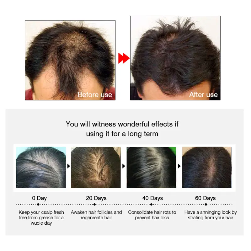 Hair Care Hair Growth Essential Oils for Hair Loss Repair and Treatment Essence Dense ARTISCARE Hair Regrowth Serum
Hair Care Hair Growth Essential Oils for Hair Loss Repair and Treatment Essence Dense ARTISCARE Hair Regrowth Serum