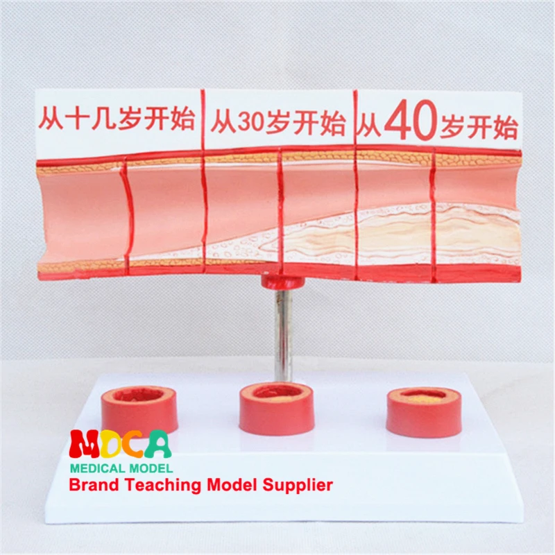 Blood Concentration of Vascular Blockage, Fatty Physiology, Vascular Pathology and Anatomy Model Medical Teaching MXG006
Blood Concentration of Vascular Blockage, Fatty Physiology, Vascular Pathology and Anatomy Model Medical Teaching MXG006