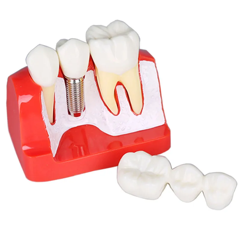 Dental Implant Teeth Model with screw Detachable 4 Times Teeth Model Magnet Implant Analysis Crown Bridge Dental Teaching model
Dental Implant Teeth Model with screw Detachable 4 Times Teeth Model Magnet Implant Analysis Crown Bridge Dental Teaching model