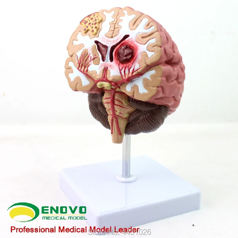 ENOVO Medical human. brain disease model brain model neurosurgery cerebral apoplexy cerebral hemorrhage
ENOVO Medical human. brain disease model brain model neurosurgery cerebral apoplexy cerebral hemorrhage