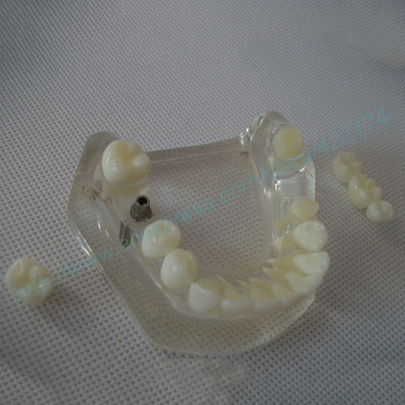 Free Shipping Implant model with bridge and caries dental tooth teeth anatomical anatomy model odontologia
Free Shipping Implant model with bridge and caries dental tooth teeth anatomical anatomy model odontologia
