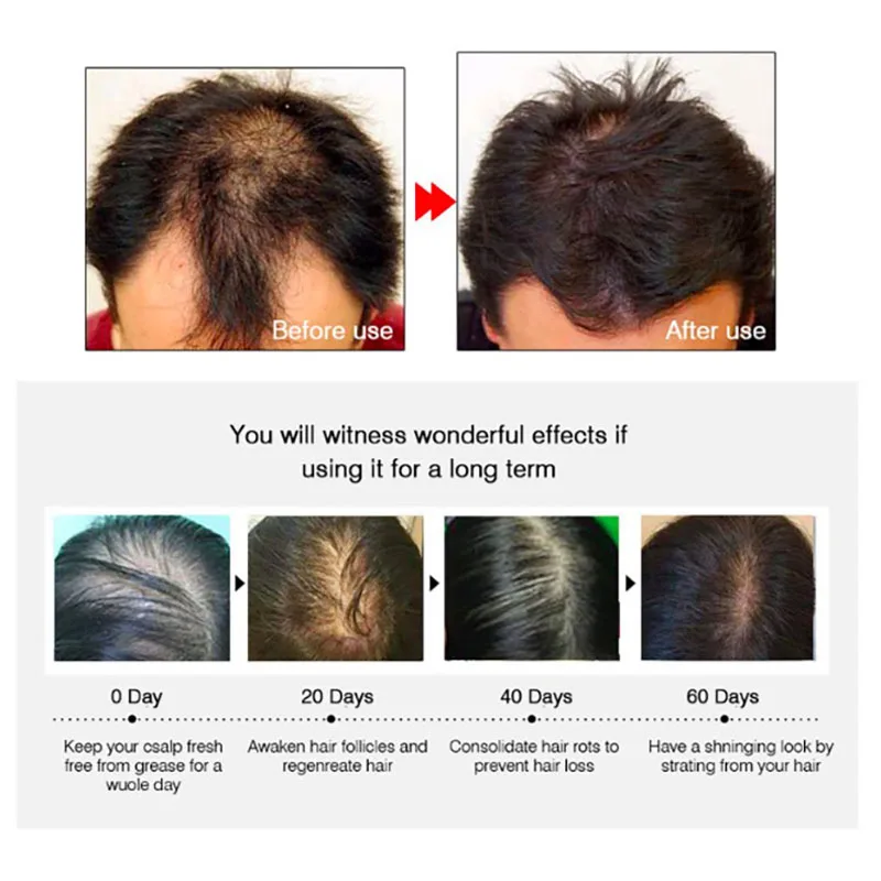 Hair Growth Essence Fast Powerful Essential Oil Liquid Scalp Treatments Preventing Hair Loss Products Soin Cheveux Crece Pelo
Hair Growth Essence Fast Powerful Essential Oil Liquid Scalp Treatments Preventing Hair Loss Products Soin Cheveux Crece Pelo