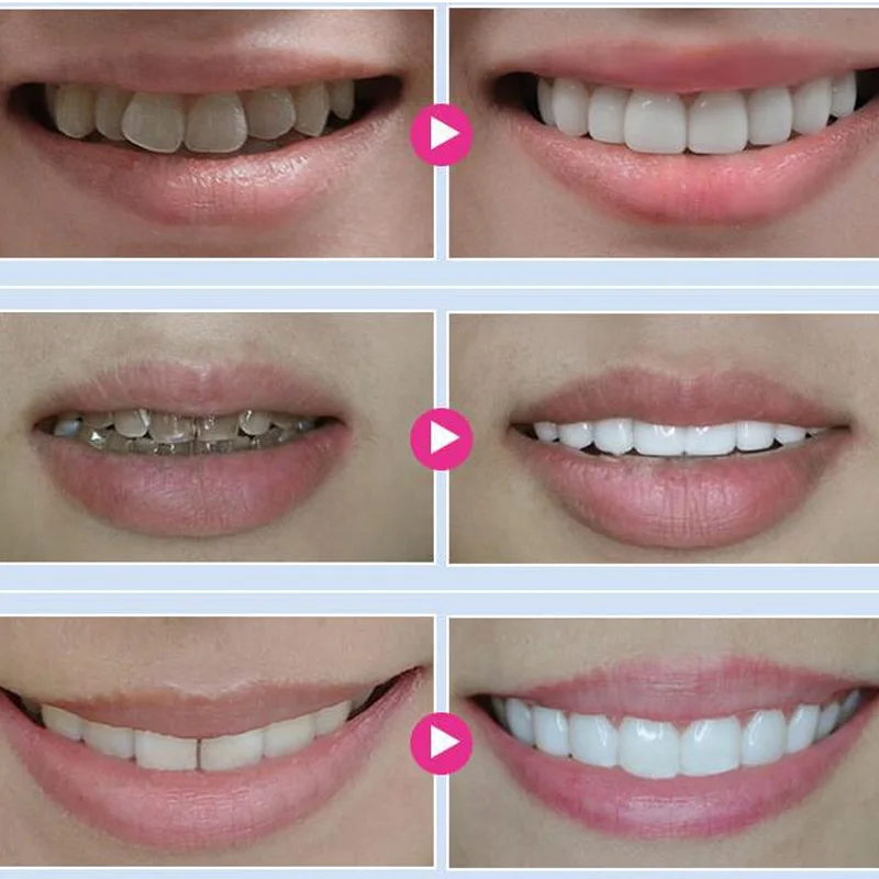 2Pcs Teeth Whitening Gel Tooth Bleaching Peroxide Oral Gel Kit Tooth Whitener Dental Equipment X0297
2Pcs Teeth Whitening Gel Tooth Bleaching Peroxide Oral Gel Kit Tooth Whitener Dental Equipment X0297