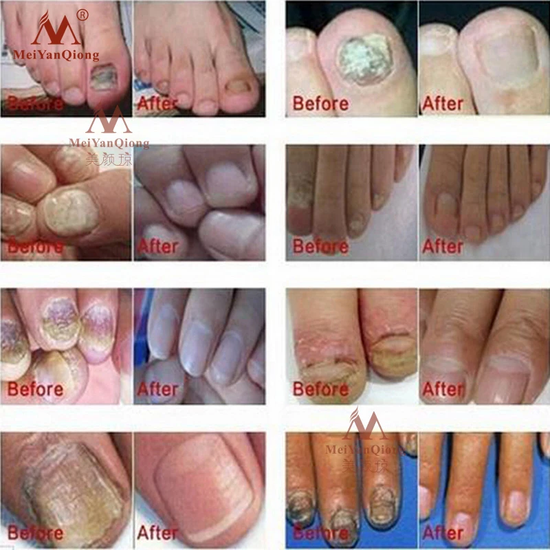 Травяное Лечение ногтей Onychomycosis противогрибковые и отбеливающие Ноги Удаление