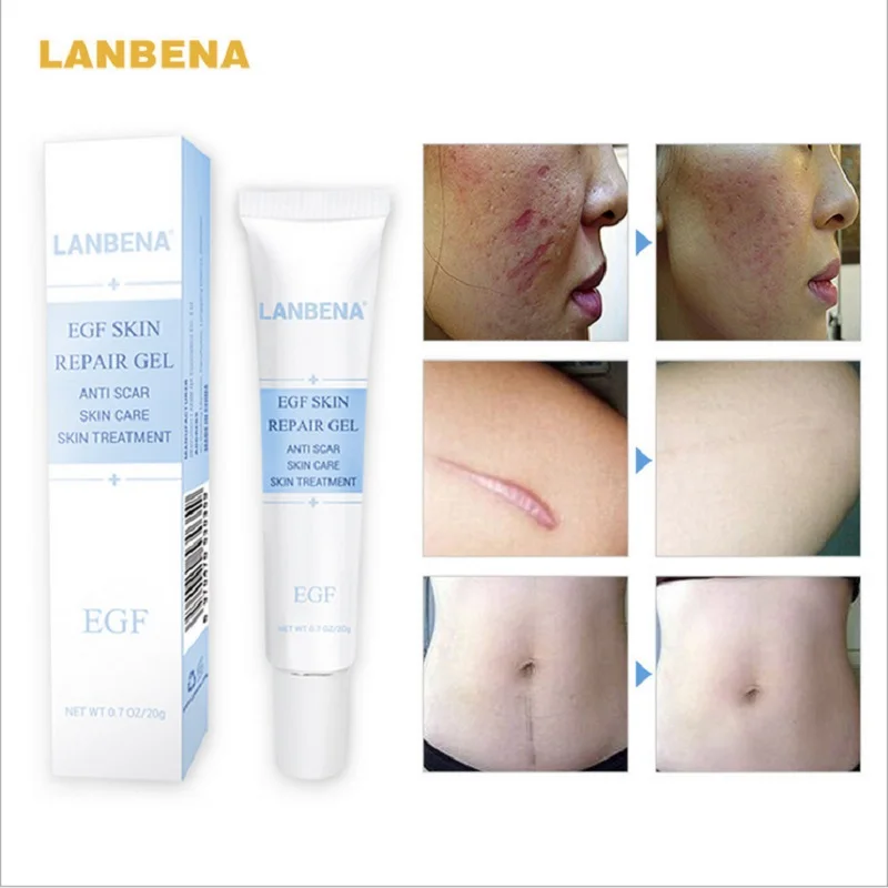10pcs LANBENA Anti Acne Cream Scar Remover EGF Recovery Cream Stretch Mark Gel Blackhead Whitening Skin Care Repair Face Cream
10pcs LANBENA Anti Acne Cream Scar Remover EGF Recovery Cream Stretch Mark Gel Blackhead Whitening Skin Care Repair Face Cream