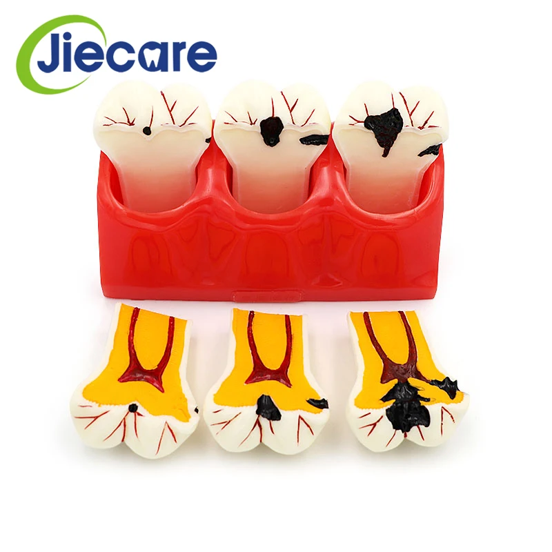 1PC Dental Denture Teeth Model Caries Disasscmbking Comparison Model Tooth Decay Model Dentist Pathologies For Medical Teaching
1PC Dental Denture Teeth Model Caries Disasscmbking Comparison Model Tooth Decay Model Dentist Pathologies For Medical Teaching