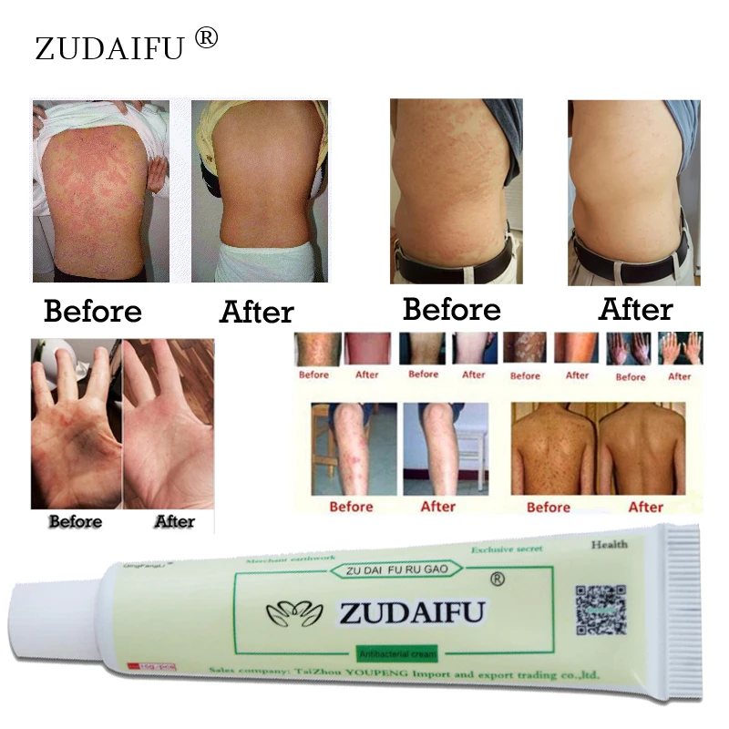 12pcs Dropship hot sell ZUDAIFU Body Psoriasis Cream Skin Care With Retail Box Remove Psoriasis Eczema Give many gift for you
12pcs Dropship hot sell ZUDAIFU Body Psoriasis Cream Skin Care With Retail Box Remove Psoriasis Eczema Give many gift for you