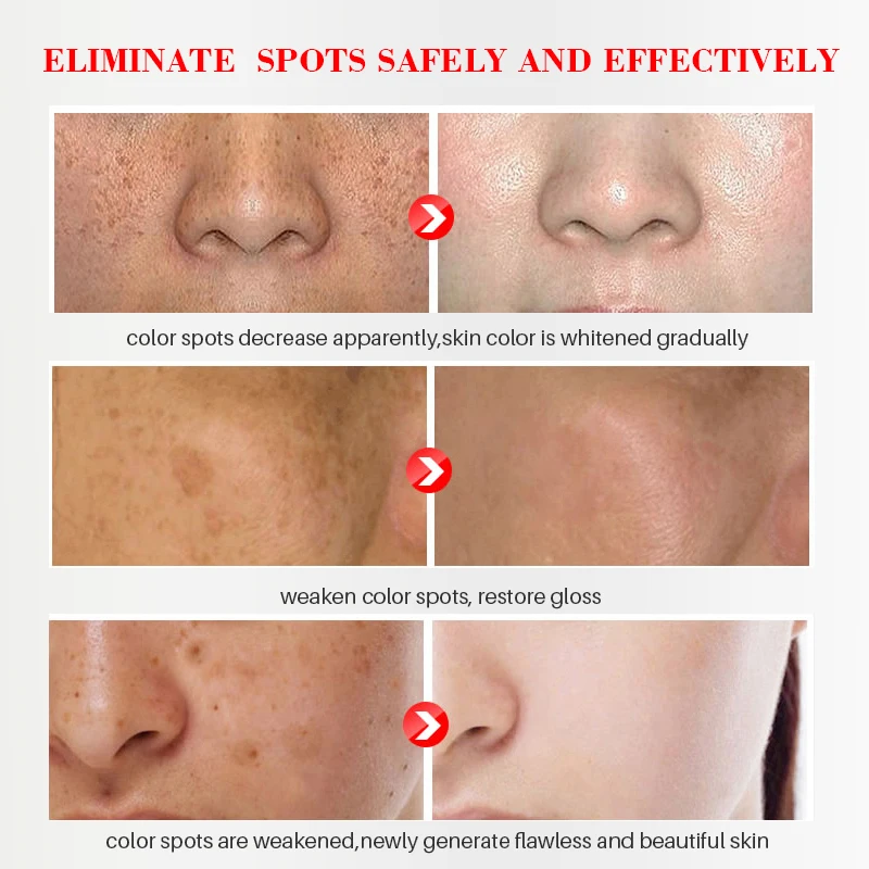 Face Whitening Cream Freckle Removal Cream Acne Spot Treatment Brighten Skin Repair Freckle Melanin Moisturizing Cream EFERO
Face Whitening Cream Freckle Removal Cream Acne Spot Treatment Brighten Skin Repair Freckle Melanin Moisturizing Cream EFERO